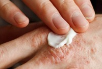 Фотографія Категорії Негормональні засоби при дерматозах