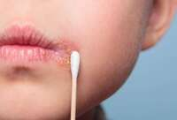 Фотографія Категорії Ліки від герпесу